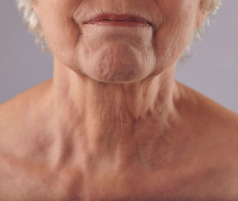 Crepey wrinkle neck